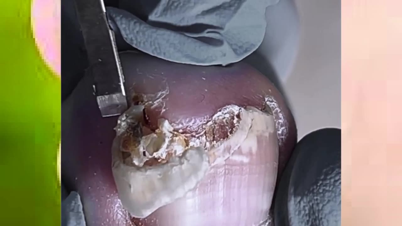#toenail #toenailremoval #ingrowntoenail #satisfying #nails