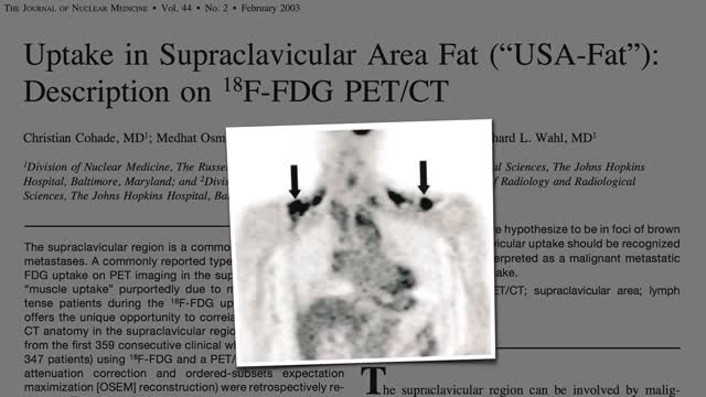 Brown Fat: Losing Weight Through Thermogenesis