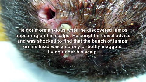 5 Most disgusting parasites ever found living inside human body