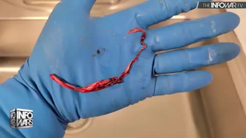MUST SEE_ Mortician Finds Massive Hand-Sized Clots In Cadavers After Vaccination