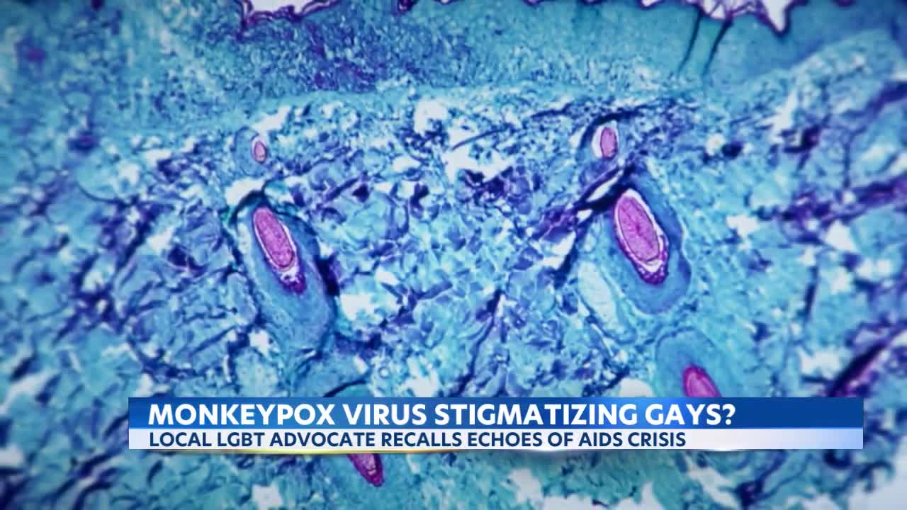 Health officials worry about impact of monkeypox outbreak and management on gay community