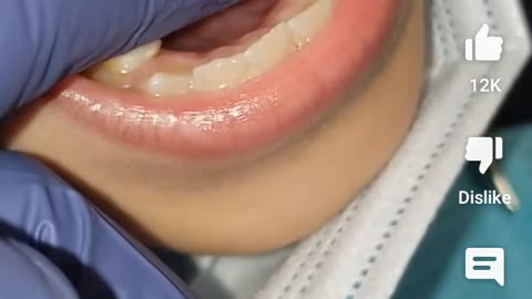 Tooth Decay