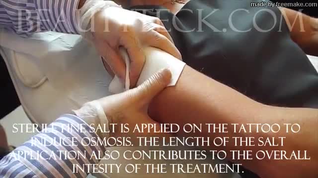 Tattoo removal using Voltaic Plasma, Beautyteck