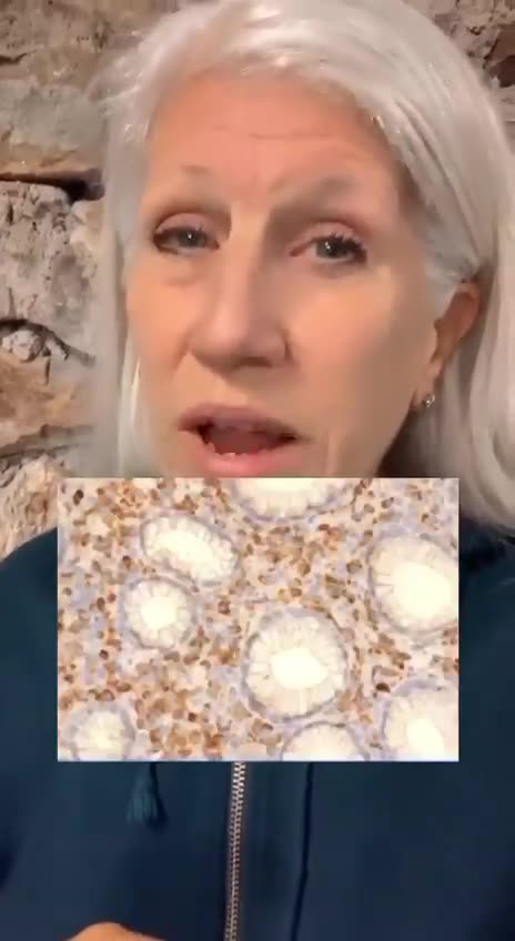 COVID VACCINE SPIKE PROTEINS IN CANCER CELLS