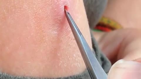 Shot botfly maggot removal