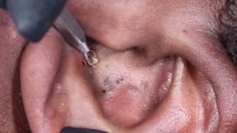 Ear Extractions