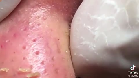 Oddly Satisfying Whitehead Removal
