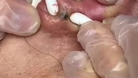 Extraction of the day