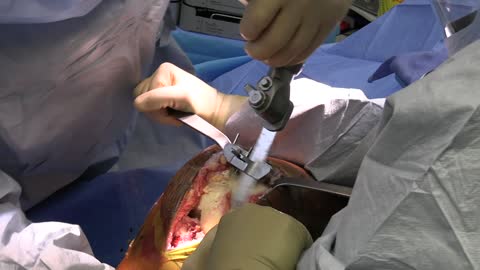 Total knee replacement