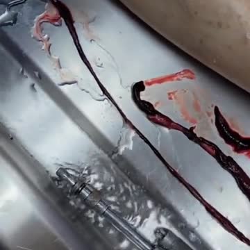 Unbelievable blood clots: video from embalmer Richard Hirschman