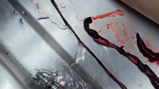 Unbelievable blood clots: video from embalmer Richard Hirschman