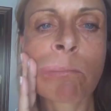 Another case of Bell’s Palsy