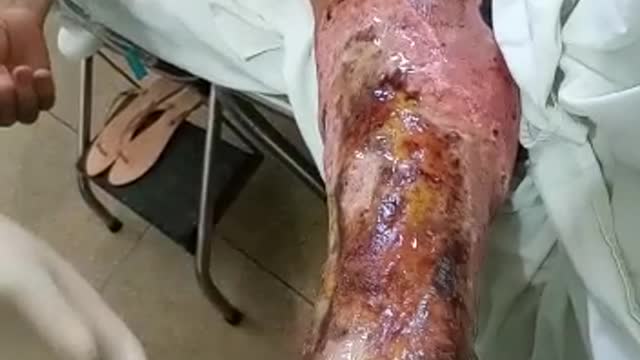 Dressing a leg with erysipele