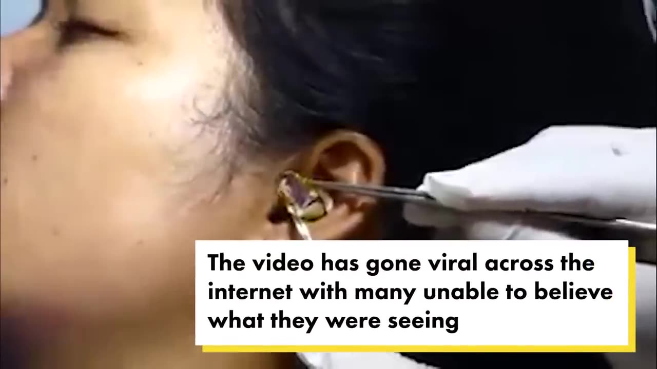 Ear operation pulling a baby snake