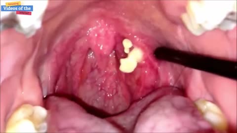 Tonsil Stones Removal