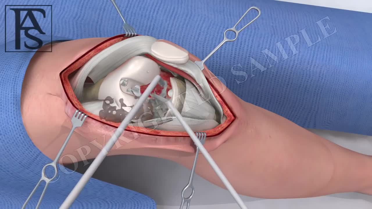 Knee surgery animation