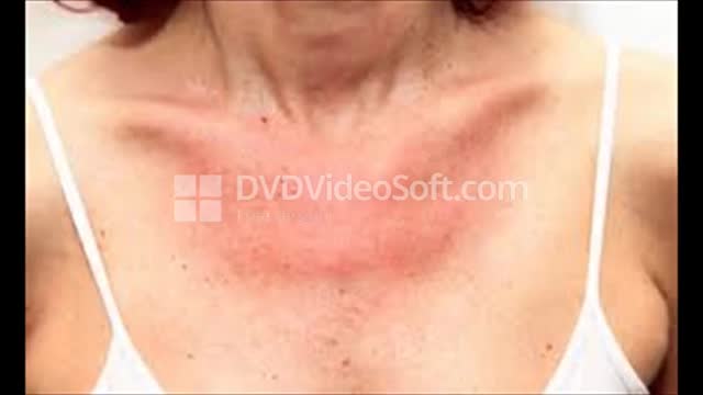 Get Rid Of All Skin Problems | Best treatment For Acne, Allergy, Pimples, Eczema, All Skin Disease
