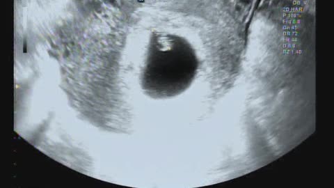 First pregnancy and ultrasound imaging