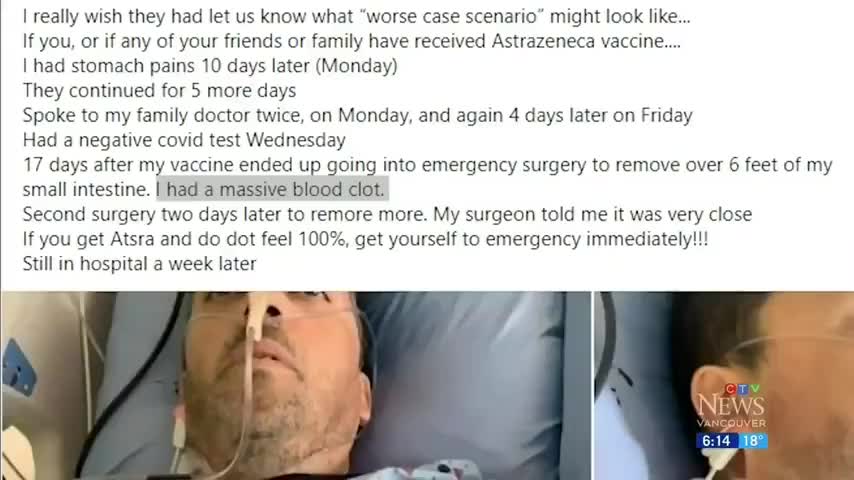 The Pfizer covid vaccine did this to this man: sever blood cloths, shared on media