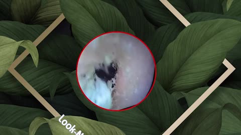 gigantic ear wax removal #51