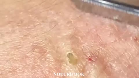 Popping tons of black heads part 1