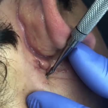 Blackhead Extraction 😎 #pimple #extraction #popping #skincare #cyst #whiteheads #blackheads