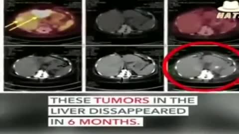 42 YEARS AGO ONE CURE FOR CANCER WAS DISCOVERED