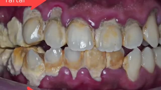 Tartar Dentist 2021 | Satisfying Dental-work