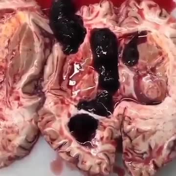 Vaccine Caused Blood 🩸 Clots in Brain 🧠