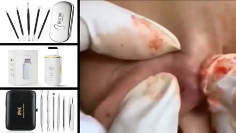 Satisfying Blackheads Removal and Pimple Popping (Part 2)