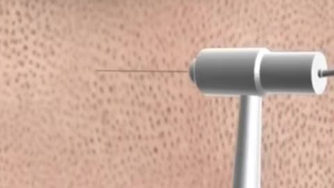 what is hair transplant.. Explain in 3D animation