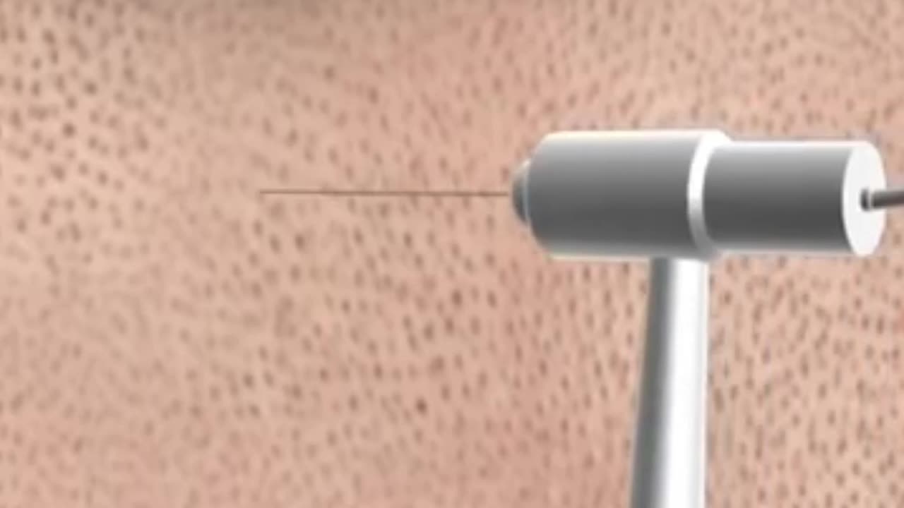 what is hair transplant.. Explain in 3D animation