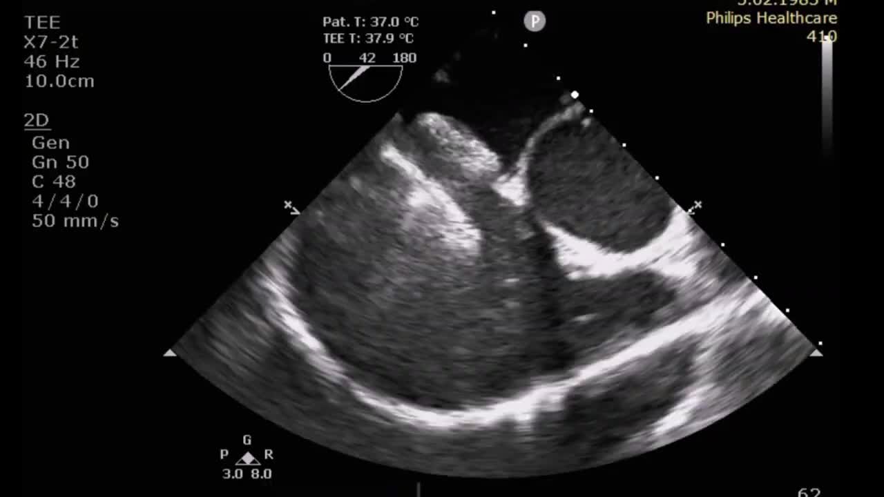 TRANSCATHETER CLOSURE OF MUSCULAR VSD AND MULTIPLE ASD IN AN ADULT: ECHO IMAGES