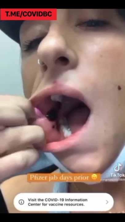 תופעת לוואי שלפוחיות דם בגוף ובפה בילדה צעירה לאחר החיסון ככה זה נראה