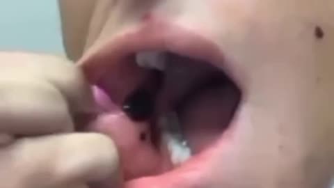 תופעת לוואי שלפוחיות דם בגוף ובפה בילדה צעירה לאחר החיסון ככה זה נראה