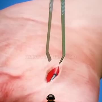 Comment fonctionne l'implant d'une micropuce ? Le futur de demain est-il dans une puce ?