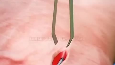Comment fonctionne l'implant d'une micropuce ? Le futur de demain est-il dans une puce ?