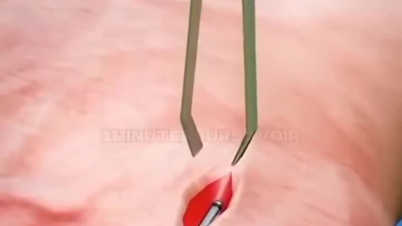 Comment fonctionne l'implant d'une micropuce ? Le futur de demain est-il dans une puce ?