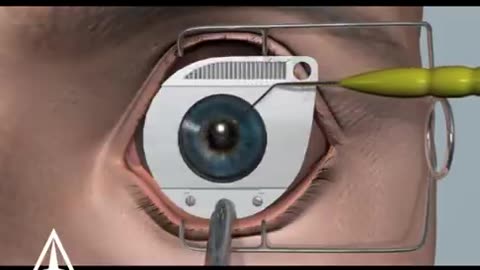 LASIK eye surgery - 3D animation