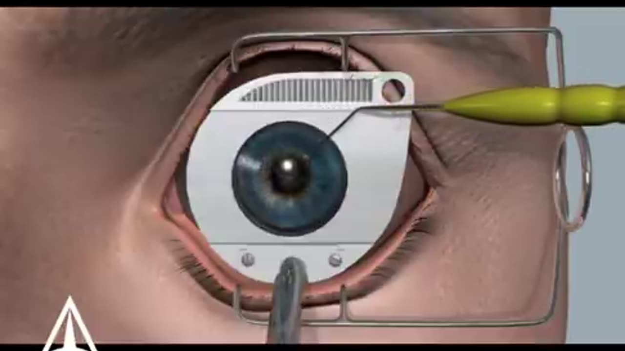 LASIK eye surgery - 3D animation