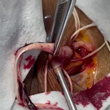 Vaxx Clots - These ‘amyloids’ were not seen in people prior to the Gene Therapy