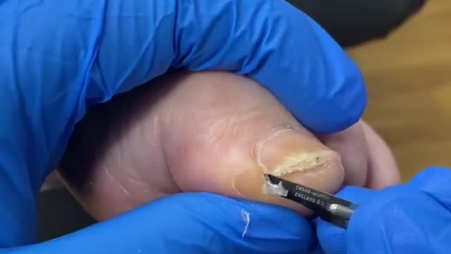 Callus removal big toe sulcus by Australian podiatrist