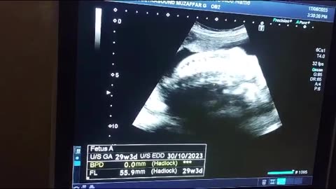 Obstetric Ultrasound (Anomaly scan) part (i)