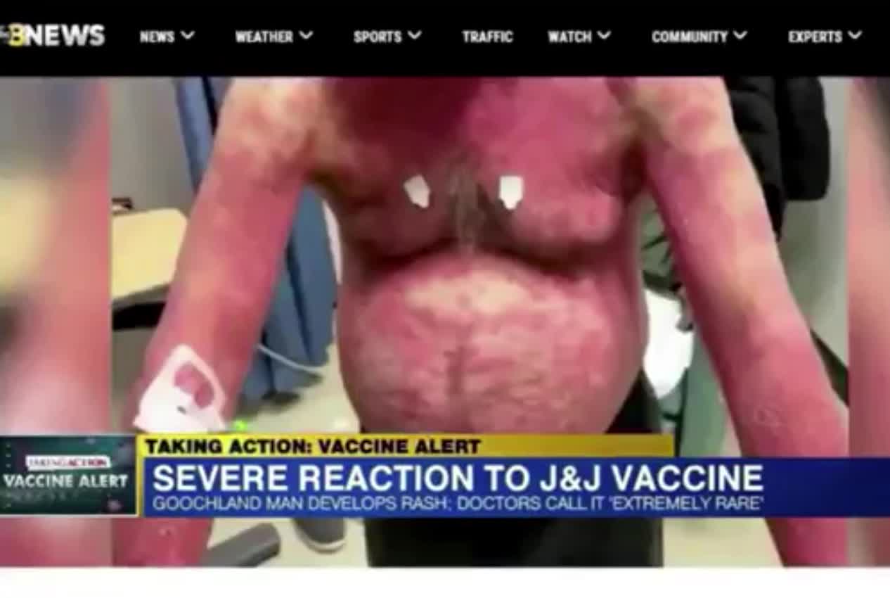 rash and swelling with vax