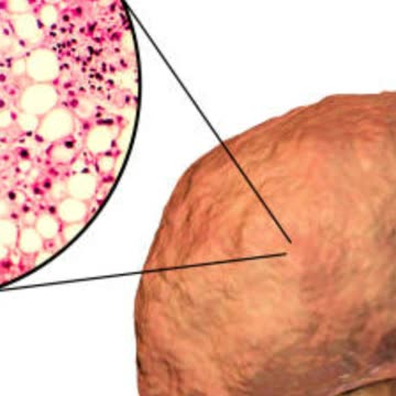 faity liver ki problem kaise door kre