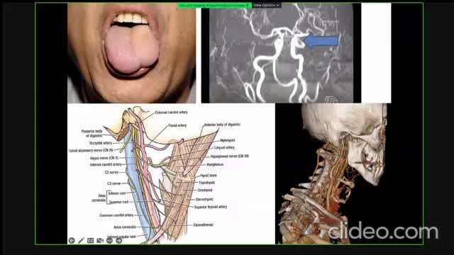 ST3.40 year old lady with difficulty speaking