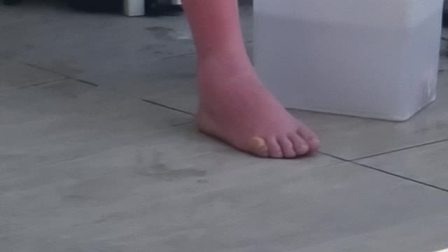 That's a Bad Sunburn