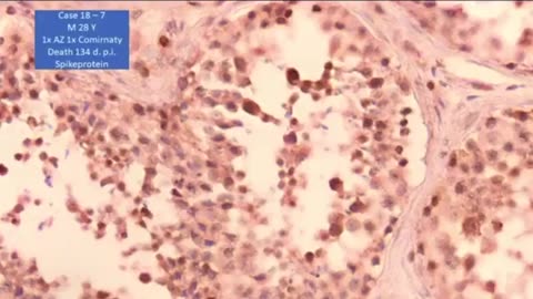 Spike Protein in Organs of the vaxxed.