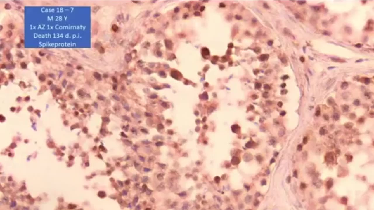 Spike Protein in Organs of the vaxxed.