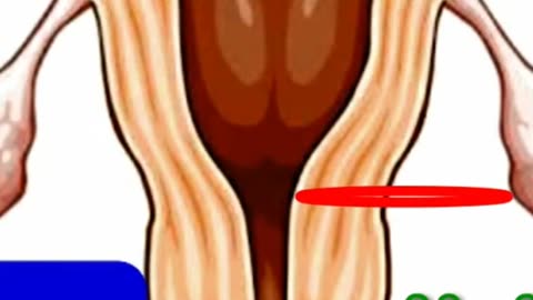 CA CERVIX l UTERINE REMANANT l ON USG 1
